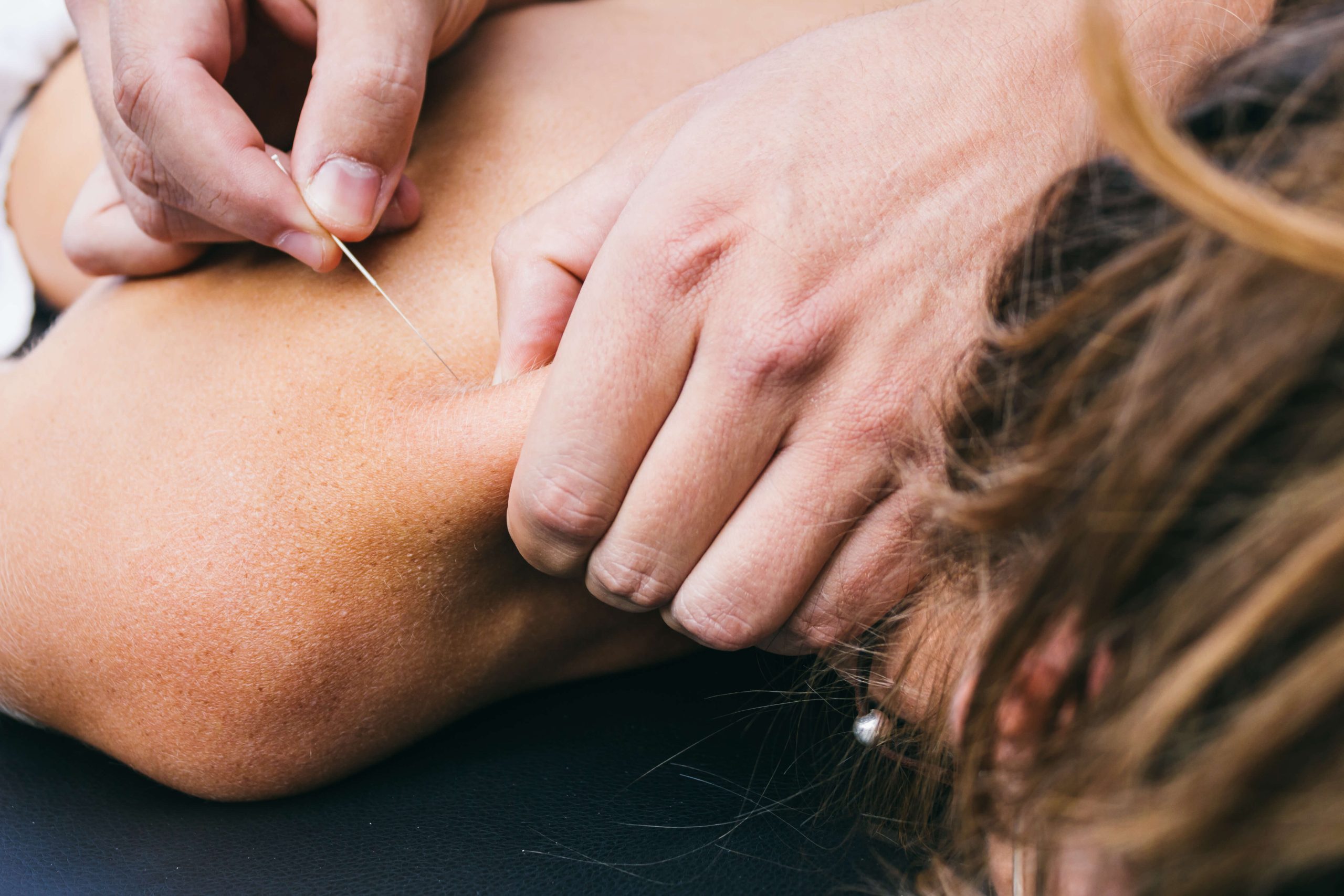 Things to Know About Dry Needling