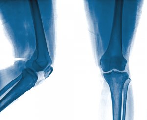 Knee Pain Causes