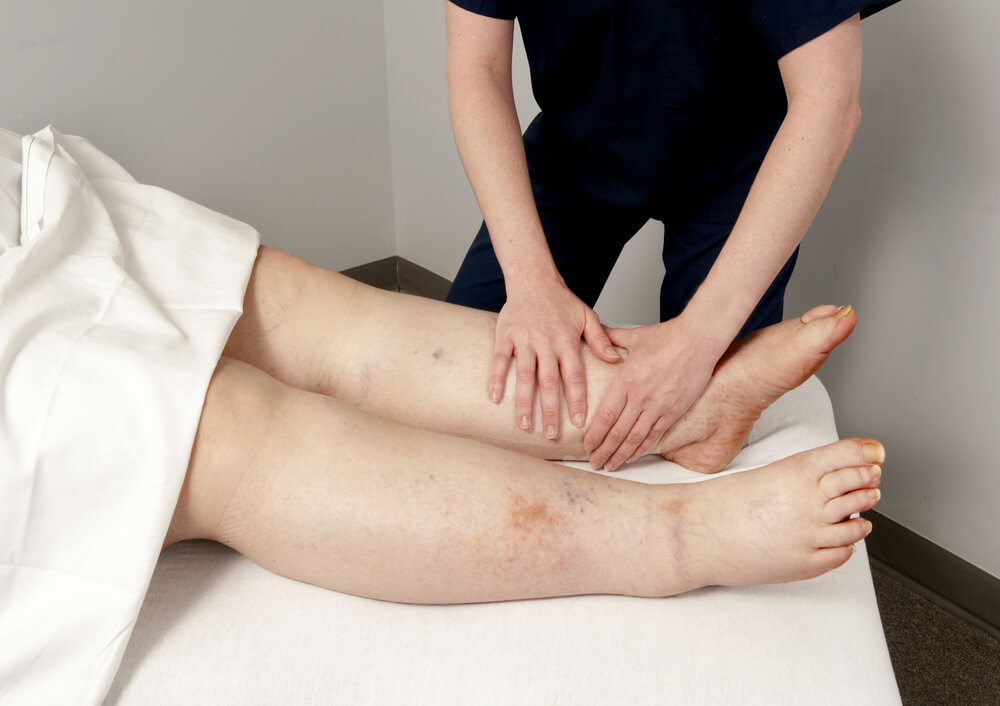 Treatment for lymphedema in New Bern, NC