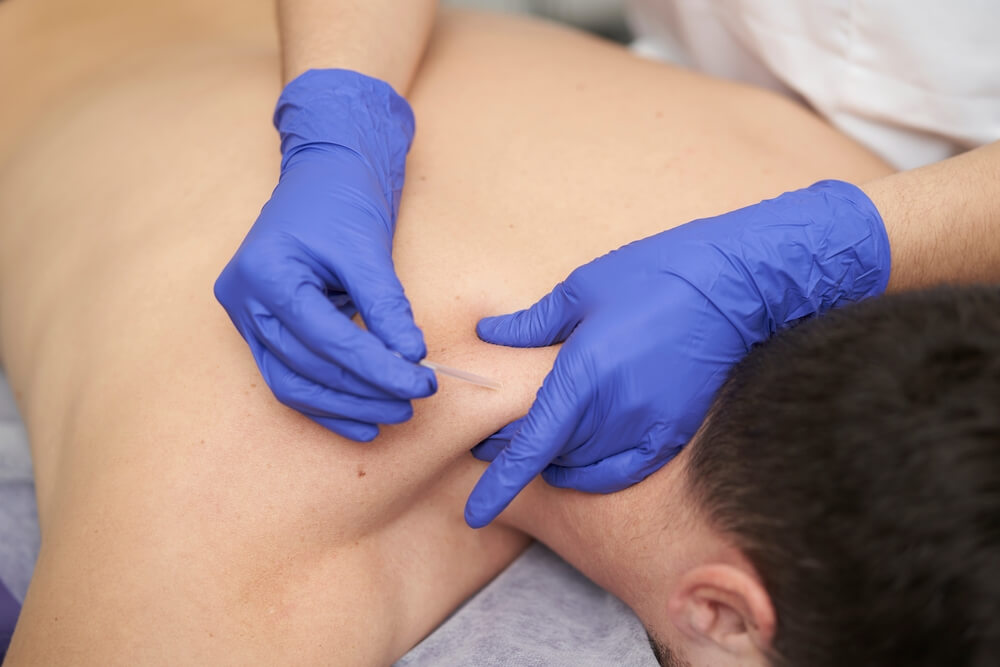 Using dry needling in physiotherapy — Pelvico Health Centre
